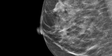 Al “Bernabeo” arriva la Mammografia con mezzo di contrasto