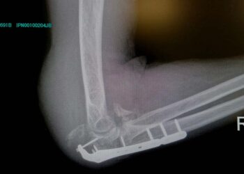 Un intervento atteso, invano, da un mese, «Nel frattempo strette di mano per il nuovo ospedale»