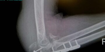 Un intervento atteso, invano, da un mese, «Nel frattempo strette di mano per il nuovo ospedale»