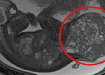 Neonata del Vastese con tumore di 800 grammi: un doppio intervento prima e dopo la nascita per salvarla