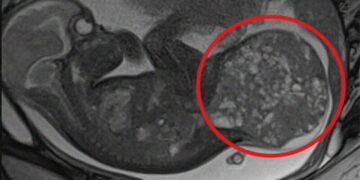 Neonata del Vastese con tumore di 800 grammi: un doppio intervento prima e dopo la nascita per salvarla