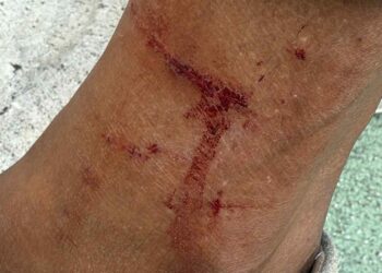 Aggrediti da un pitbull si arrampicano su una ringhiera: feriti, finiscono in ospedale