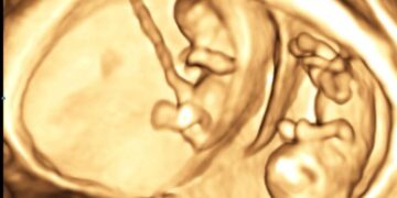 Boom di nascite gemellari all’ospedale di Chieti