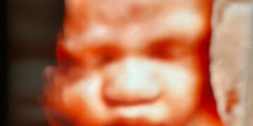 Raro caso di anemia fetale a Chieti, bimba salvata da trasfusioni in utero